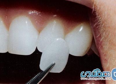 مزایا و معایب انواع روکش دندان