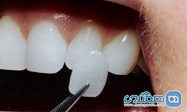 مزایا و معایب انواع روکش دندان